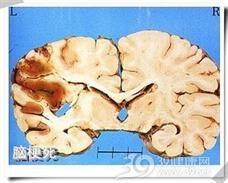 脑梗可以吃角瓜吗,角瓜的适宜与禁忌